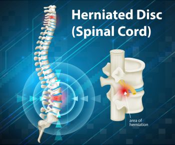 image of herniated disc and spinal cord