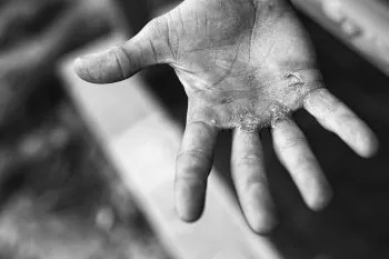 hands showing blisters from rowing machine