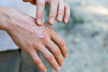 rowing blisters on hands