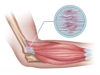 Tendonitis from using a rowing machine