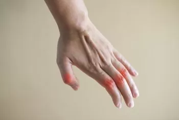 closeup of a hand with rheumatoid arthritis